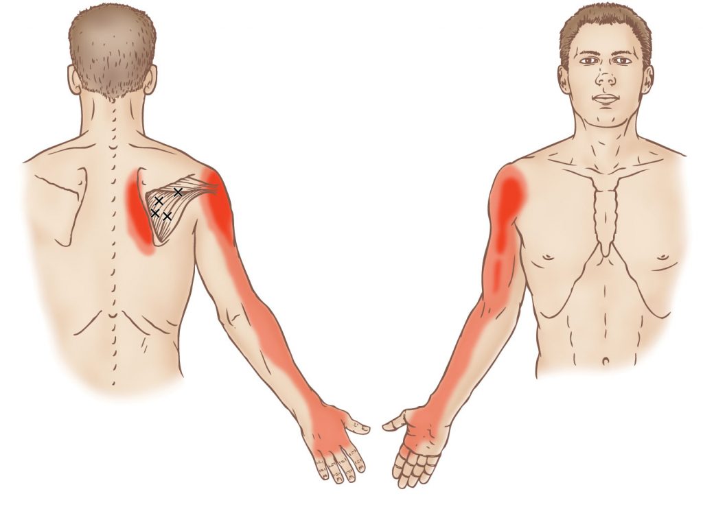 Right-infraspinatus-Trigger-Point-1024×758 | Bodywise Bali-Therapy Centre